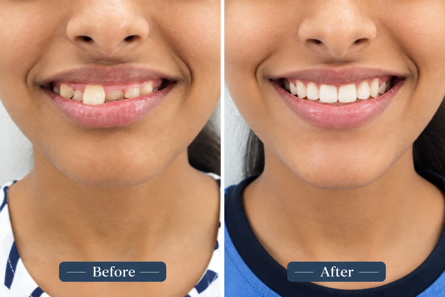 Before and after correction of crowded teeth with braces